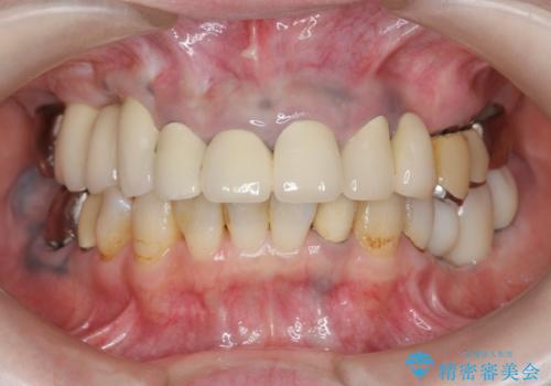 全顎的 虫歯治療 インプラント補綴の治療中