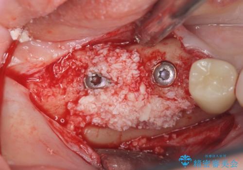 くいしばりで割れたブリッジの支台歯　インプラント再補綴の治療中
