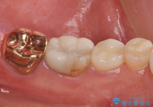 昔いれたクラウンが割れたので金属の被せ物を入れたいの治療後
