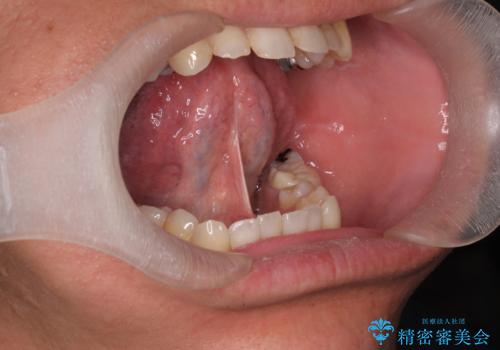 舌小帯・上唇小帯切除の症例 治療前