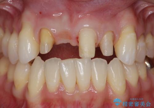 吸収し喪失した前歯、ブリッジによる審美性の回復の治療中