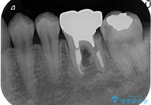 【歯牙移植】親知らずを移植して、インプラントを回避。の治療前