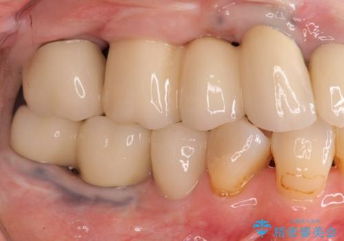 全顎的 虫歯治療 インプラント補綴の治療後