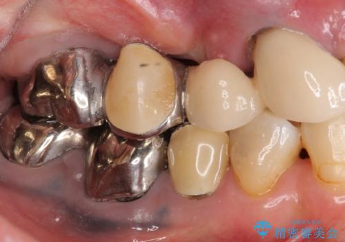 全顎的 虫歯治療 インプラント補綴の治療前