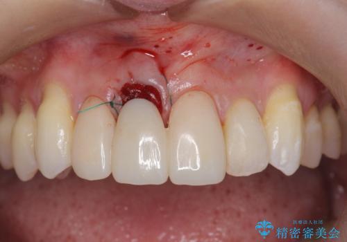 吸収し喪失した前歯、ブリッジによる審美性の回復の治療前
