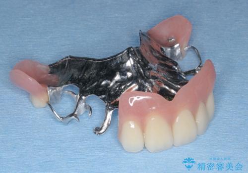 [ 無歯顎の治療 ]   前歯部義歯と臼歯部インプラント補綴