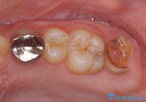 [ 歯肉縁下カリエス ]    歯周外科を行い、歯を残すの症例 治療前