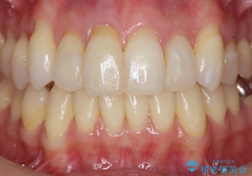 吸収し喪失した前歯、ブリッジによる審美性の回復の治療前