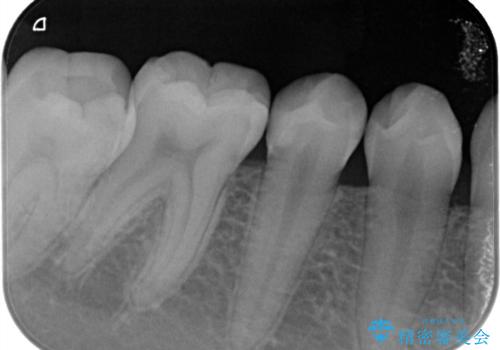 定期検診に来たら虫歯があった。の治療後