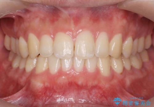 前歯のすれ違い　マウスピース矯正の症例 治療後