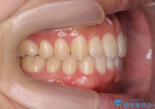 前歯のすれ違い　マウスピース矯正の治療後