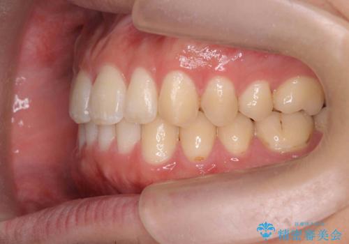 前歯のすれ違い　マウスピース矯正の治療後