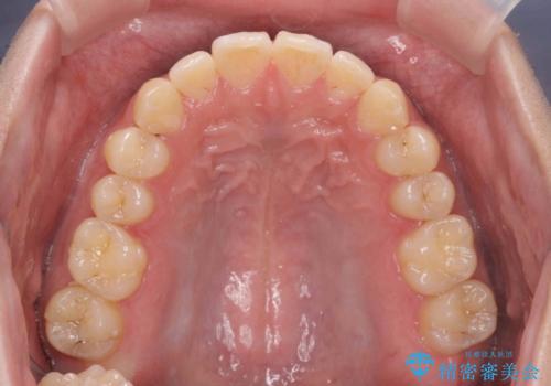 前歯のすれ違い マウスピース矯正の治療後