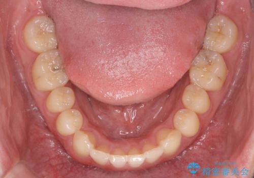 前歯のすれ違い マウスピース矯正の治療後