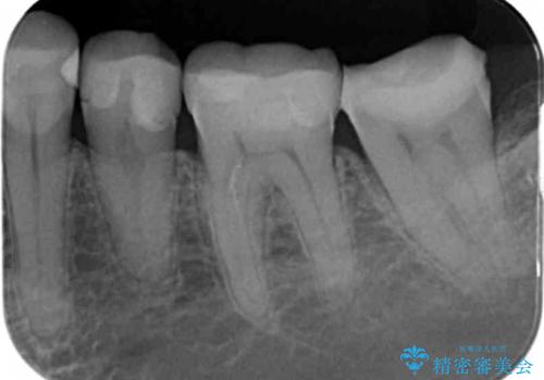 昔いれたクラウンが割れたので金属の被せ物を入れたいの治療前