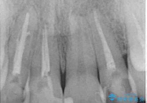 吸収し喪失した前歯、ブリッジによる審美性の回復の治療前