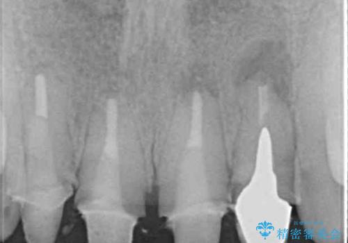 汚れた仮歯が気になる 前歯のオールセラミッククラウンの治療前