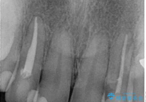 【モニター】前歯の変色とデコボコを改善 インビザラインとオールセラミックの治療前