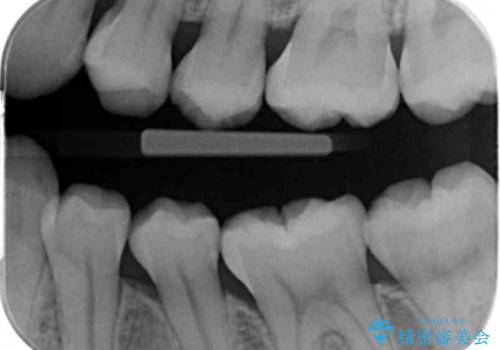 奥歯の虫歯 セラミックインレーでの治療の治療前