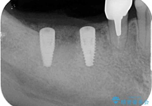 くいしばりで割れたブリッジの支台歯　インプラント再補綴の治療中