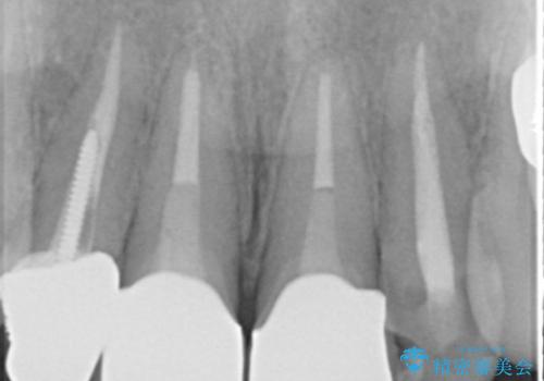 前歯が取れたの治療後