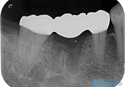 他院で奥歯の初めての根の治療を10回以上通った上に抜歯と言われた　歯茎が腫れて痛いの治療後