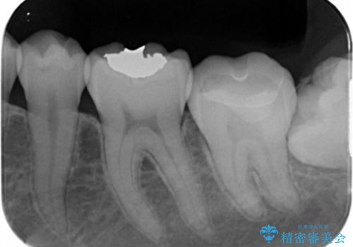 矯正前の虫歯治療の治療後
