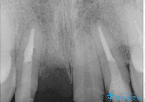 吸収し喪失した前歯、ブリッジによる審美性の回復の治療中