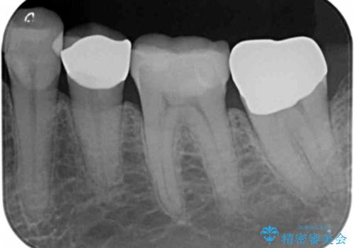 昔いれたクラウンが割れたので金属の被せ物を入れたいの治療後