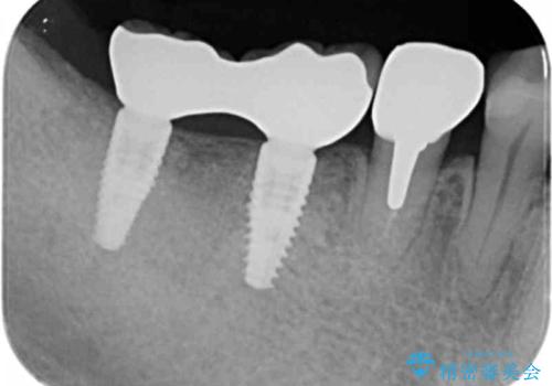 くいしばりで割れたブリッジの支台歯　インプラント再補綴の治療後
