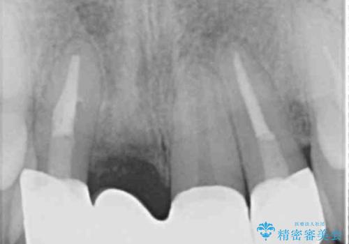 吸収し喪失した前歯、ブリッジによる審美性の回復の治療後