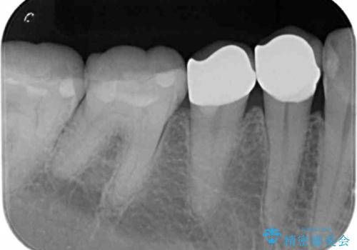 樹脂で継ぎ接ぎになった歯 セラミッククラウンでの治療の治療後