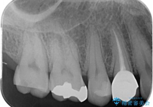 奥の歯に穴が空いているの治療前
