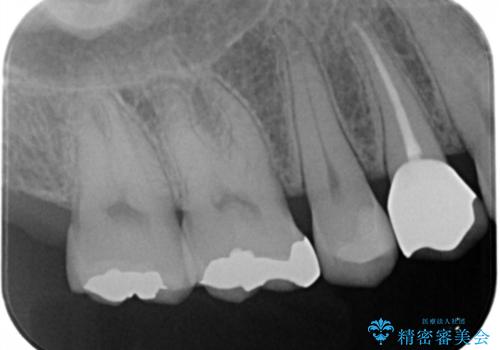 奥の歯に穴が空いているの治療後