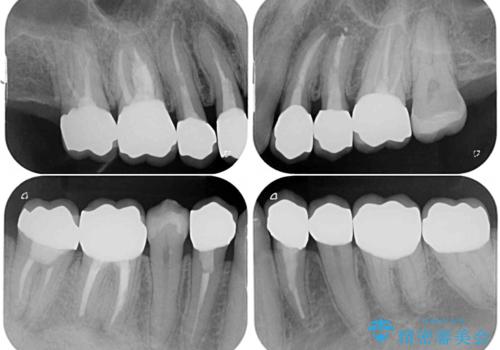 飛び出した前歯と目立つ銀歯 矯正とセラミックの総合歯科診療の治療後
