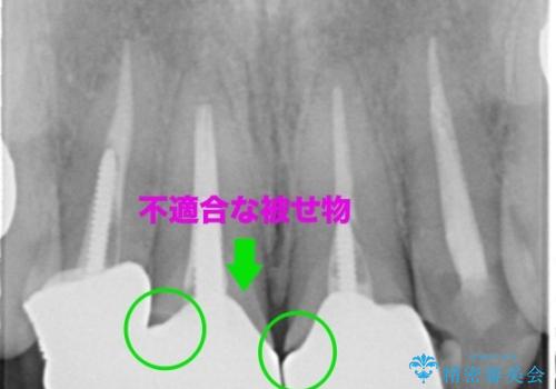 前歯が取れたの治療前