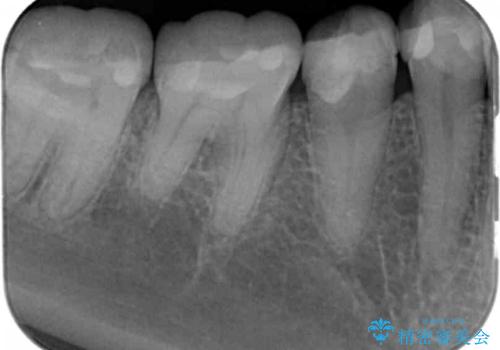 樹脂で継ぎ接ぎになった歯 セラミッククラウンでの治療の治療前