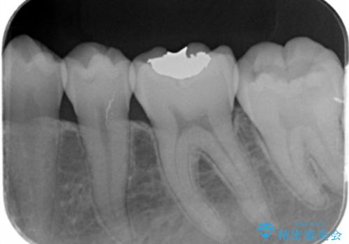 矯正前の虫歯治療の治療前