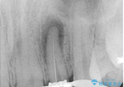 鼻の下を押すと痛い 前歯の根管治療とオールセラミッククラウンの治療中