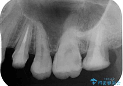 [ 歯肉縁下カリエス ]    歯周外科を行い、歯を残すの治療中