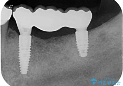 インプラントや歯周外科処置を用いた奥歯の補綴治療の治療後
