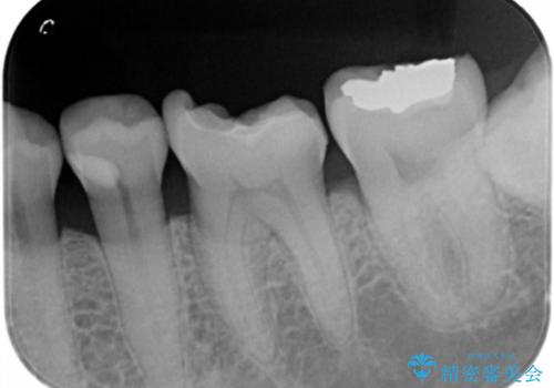 銀歯が取れた。の治療前
