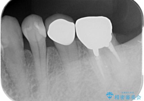 銀歯のやりかえ。の治療前