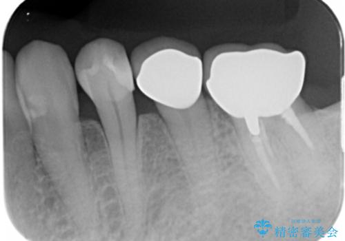 銀歯のやりかえ。の治療後