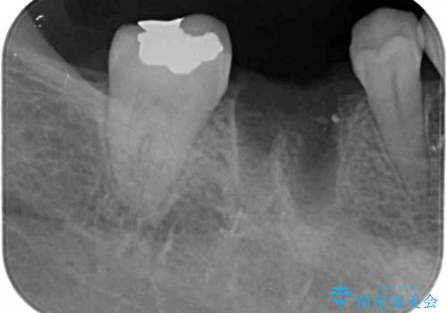 他院で奥歯の初めての根の治療を10回以上通った上に抜歯と言われた　歯茎が腫れて痛いの治療中