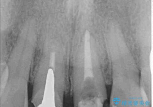 見栄えの悪い仮歯 前歯のオールセラミック治療の治療中
