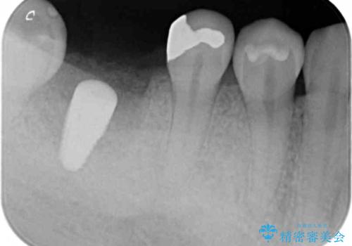 保存不可能な虫歯、インプラントによる機能回復の治療中