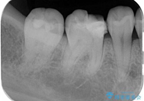 食べ物食べたら歯が欠けた。の治療前