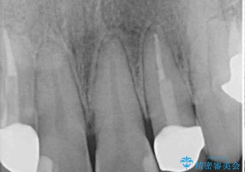 【モニター】前歯の変色とデコボコを改善 インビザラインとオールセラミックの治療後