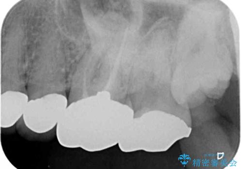 インプラントや歯周外科処置を用いた奥歯の補綴治療の治療前
